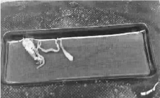 11歲男孩腦中取7厘米活蟲 常吃燒烤麻辣燙