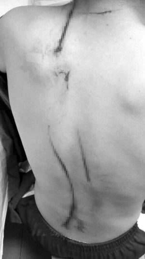 受傷男生背上的傷口網絡圖片